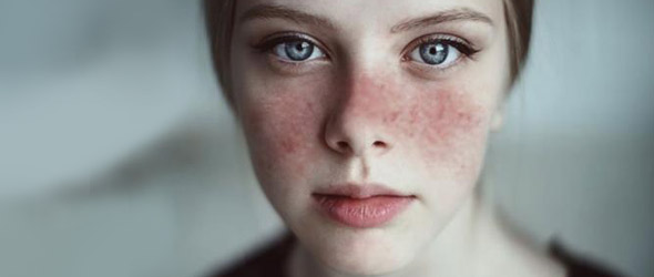 Lupus eritematoso sistemico: in MG la vera sfida è la diagnosi precoce