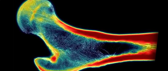 AI prevede il rischio di frattura con immagini a super-risoluzione