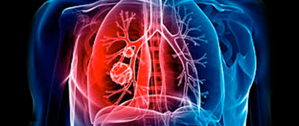 Identificato il meccanismo della trombosi: offre un razionale per l’uso precoce di anticoagulanti