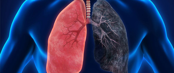 Tumore al polmone e fumo: la relazione non vale per tutti