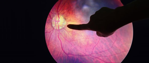 Retinopatia diabetica, la diagnosi con intelligenza artificiale