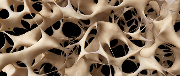 Rimodellamento osseo e metastasi, un legame c’è