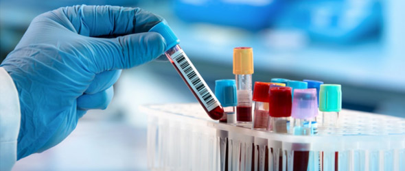 Elevata accuratezza della biopsia liquida nel cancro al pancreas in fase iniziale