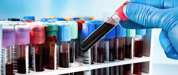 La biopsia liquida migliora la scelta della terapia per il tumore mammario