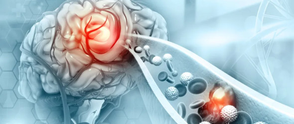 La regolazione del colesterolo influenza lo sviluppo di Alzheimer
