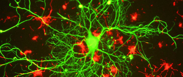 Sclerosi Multipla: i neurofilamenti rivelano la malattia invisibile