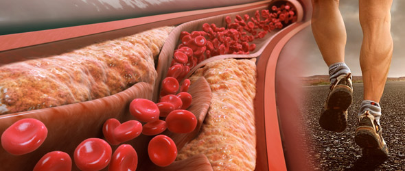 L’attività fisica facilita la progressione della placca coronarica? Così pare…