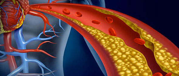 Ipercolesterolemia primaria, identificare i pazienti non a target e razionalizzare le terapie