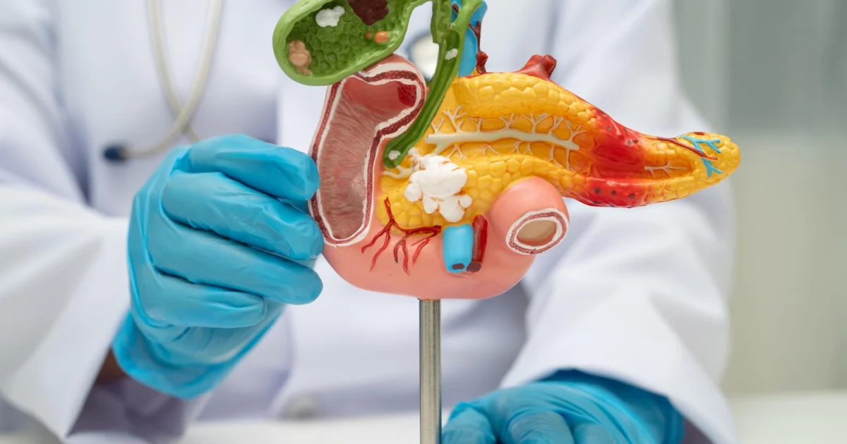 Tumore del pancreas, Aiom: “Subito l’uso compassionevole di daraxonrasib”