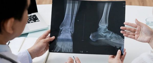  L’osteopatia diabetica interessa molti giovani