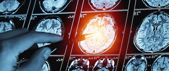 Malattia di Parkinson: arriva la formulazione sublinguale di apomorfina